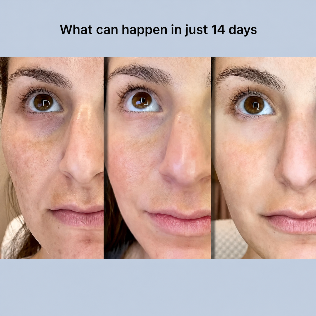 Lifting face strips | Instantly smooth & tighten | Anti-wrinkle care without surgery | YouthLift Renew