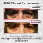 LumiLift 2-in-1 Eye Rejuvenator — Red Light, Microcurrent, 10-Minute