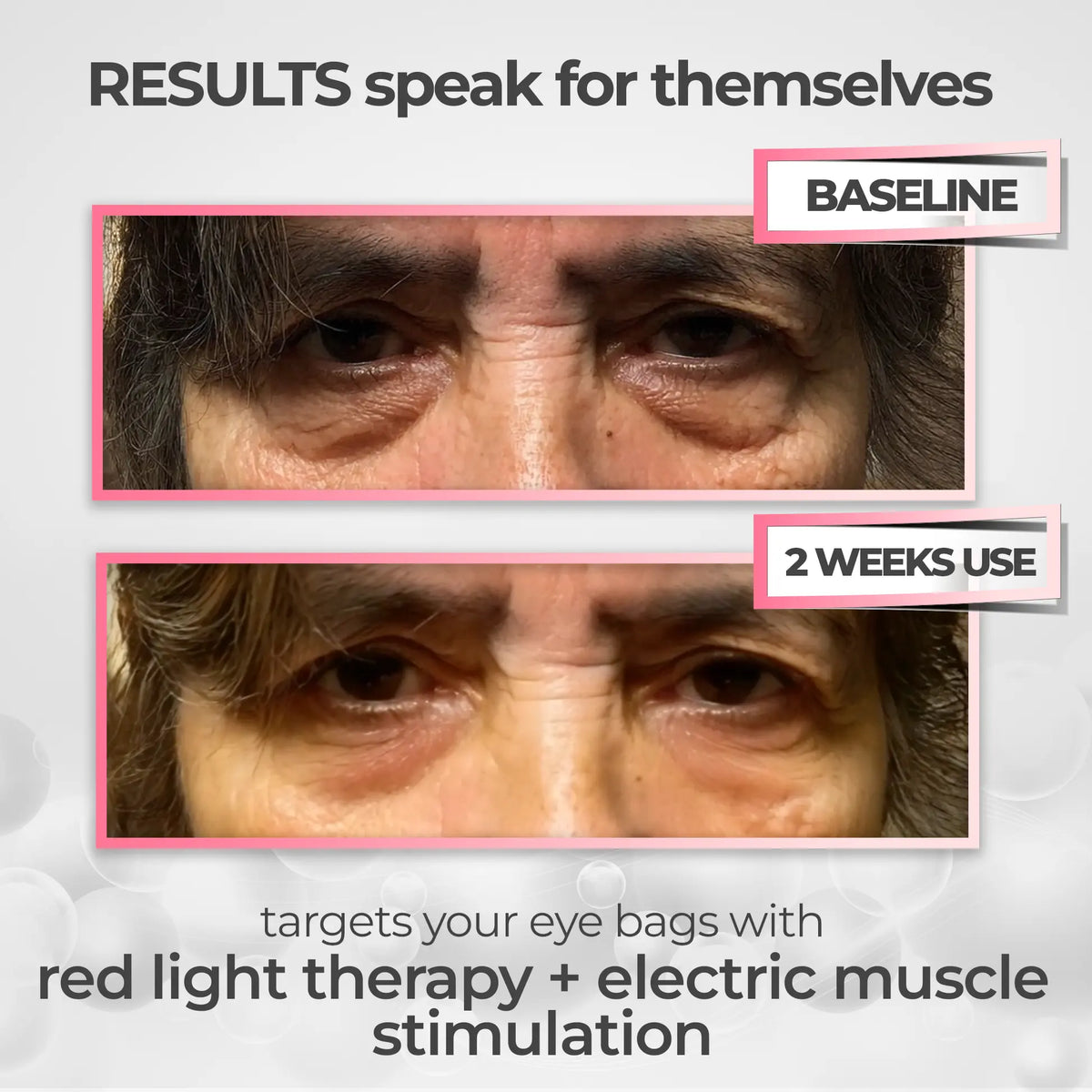 LumiLift 2-in-1 Eye Rejuvenator — Red Light, Microcurrent, 10-Minute