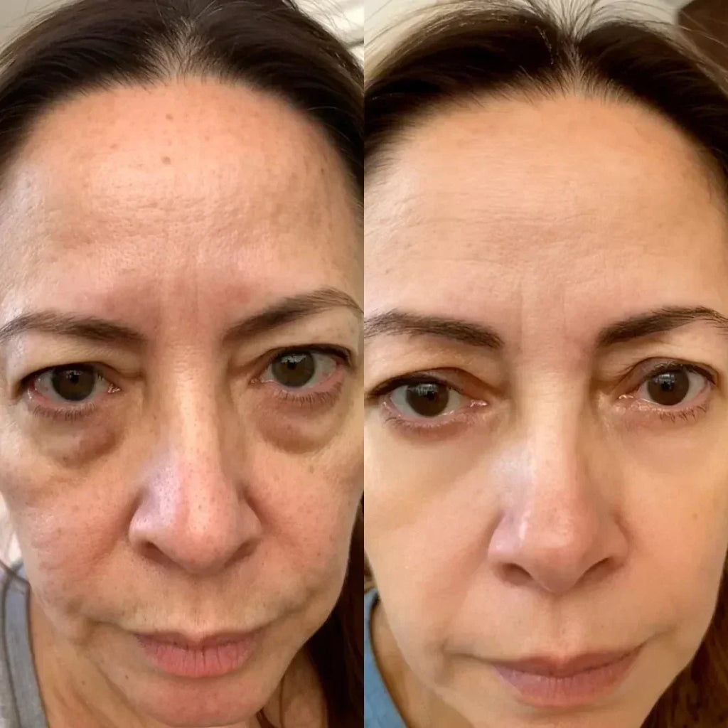 LumiLift 2-in-1 Eye Rejuvenator — Red Light, Microcurrent, 10-Minute
