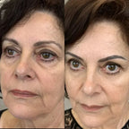 LumiLift 2-in-1 Eye Rejuvenator — Red Light, Microcurrent, 10-Minute