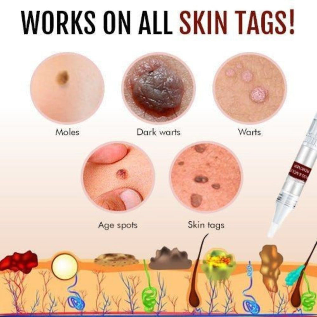 Boneroshop | Natural Skin Tag & Mole Remover Pen