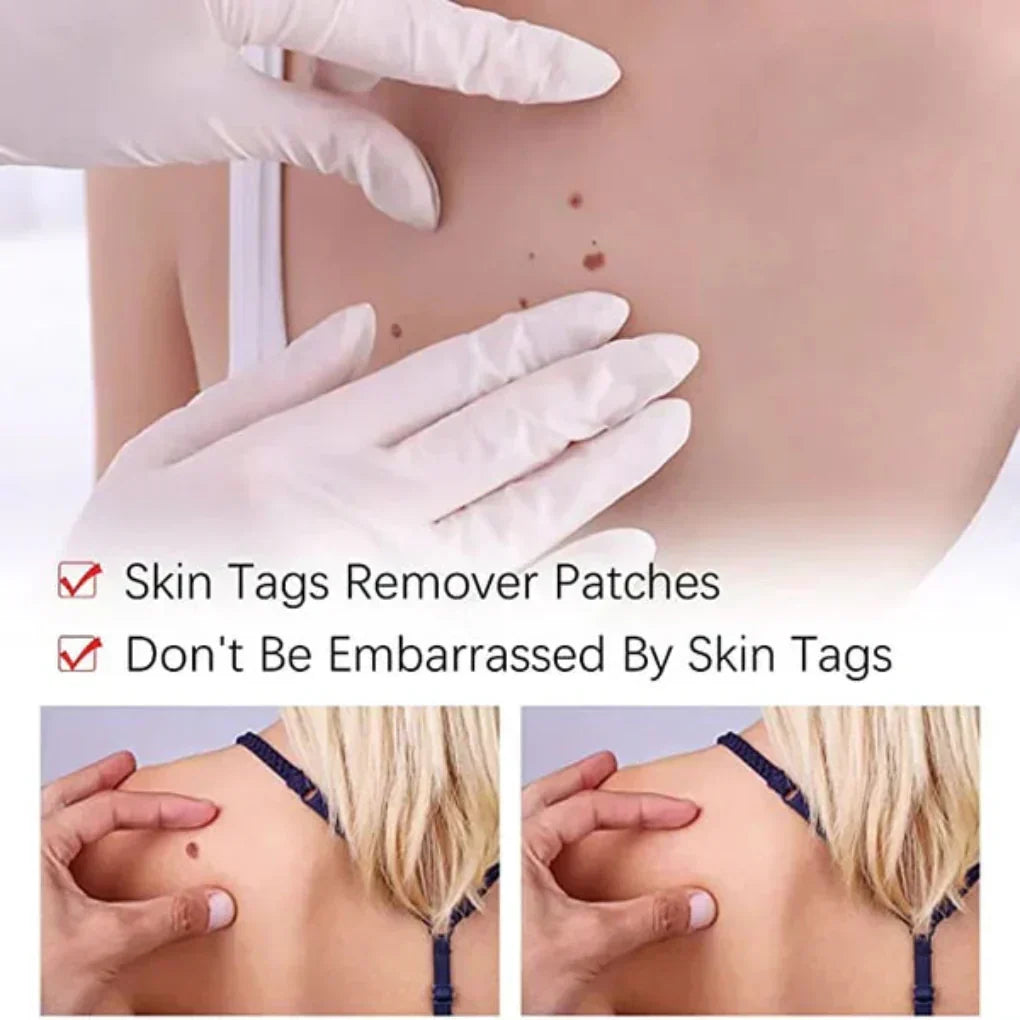 Boneroshop | Natural Skin Tag & Mole Remover Pen